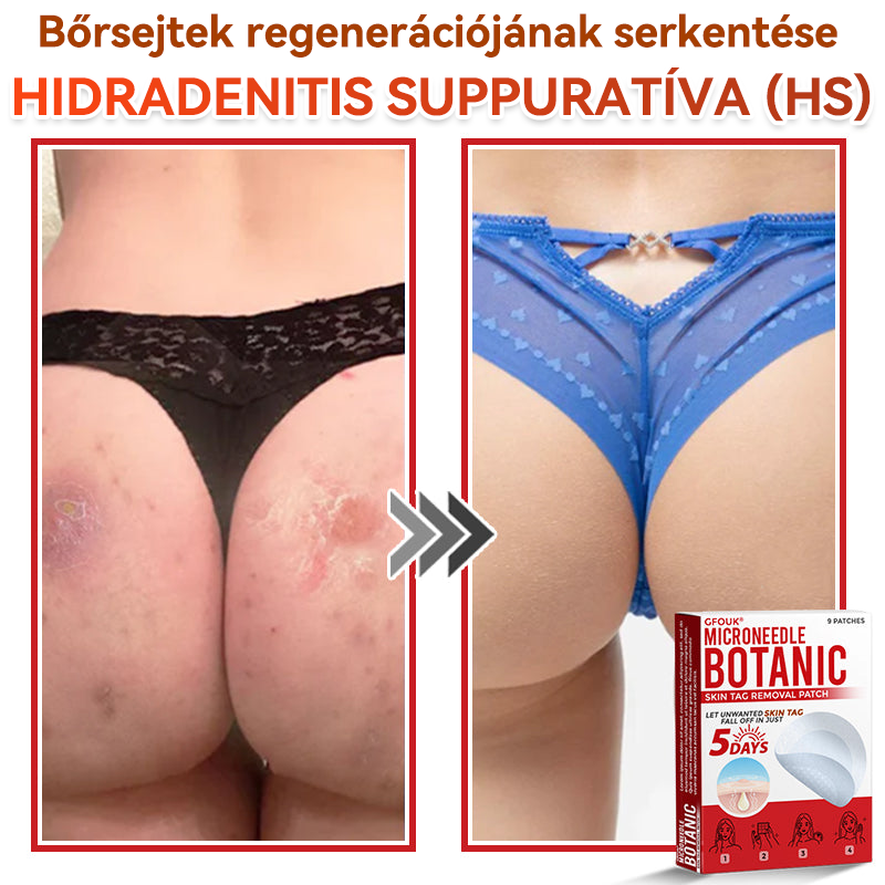 ✅✅ GFOUK® Mikrotűs növényi bőrkinövés eltávolító tapasz